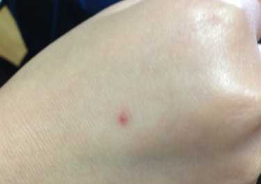 被蚊子咬了以后如何止痒