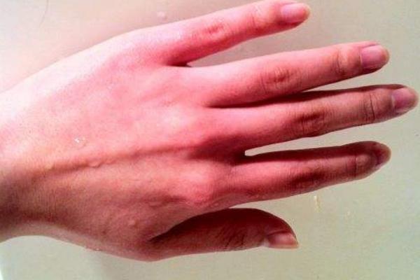 铁棍山药过敏怎么办