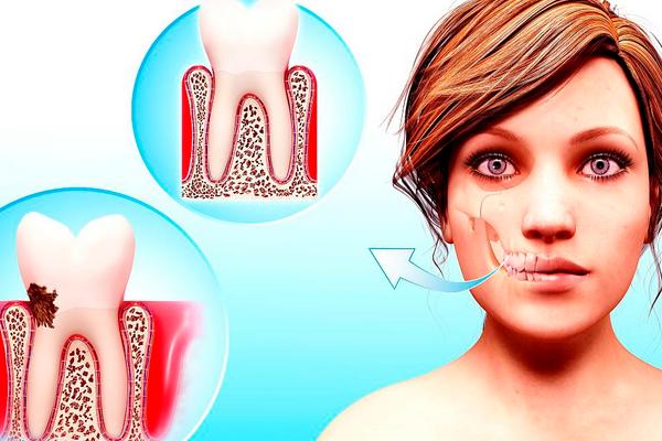 花椒能治牙疼吗?