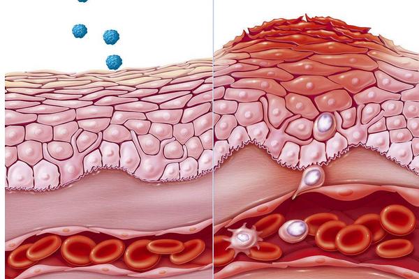小麦过敏怎么办?
