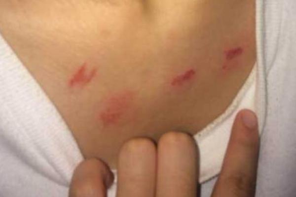 脖子上被种草莓怎么快速消除