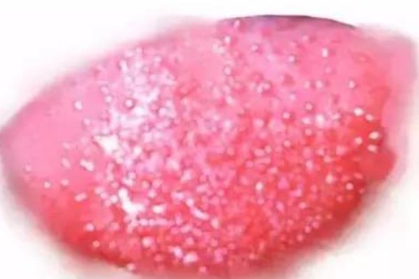 杨梅舌是什么病-