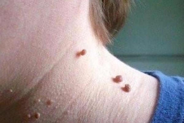 无花果汁液治疗扁平疣有用吗