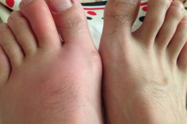 被蜈蚣咬了有什么症状?