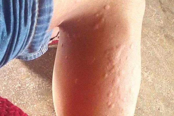 荨麻疹可以吃花生吗?