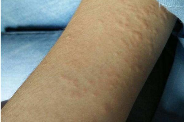 荨麻疹可以吃花生吗?