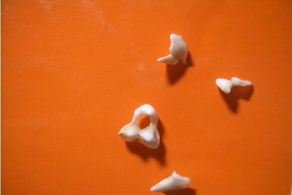 梦见牙齿掉了是什么意思 女人梦见掉了很多颗牙齿有什么预兆