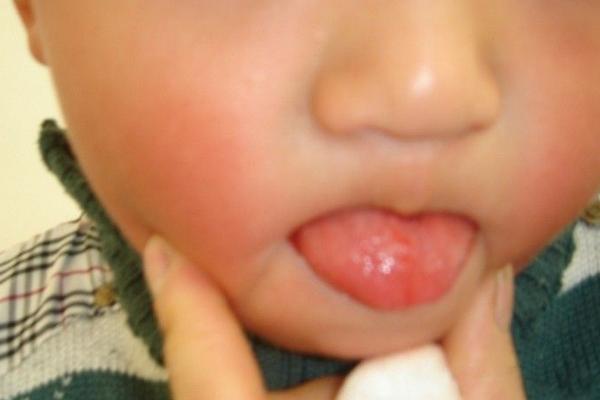 草莓舌苔是怎么回事 草莓舌怎么治疗