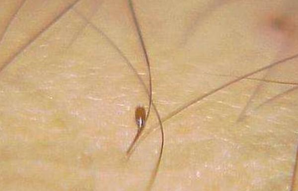 小孩头上长虱子怎么办 女孩头上有虱子怎么办